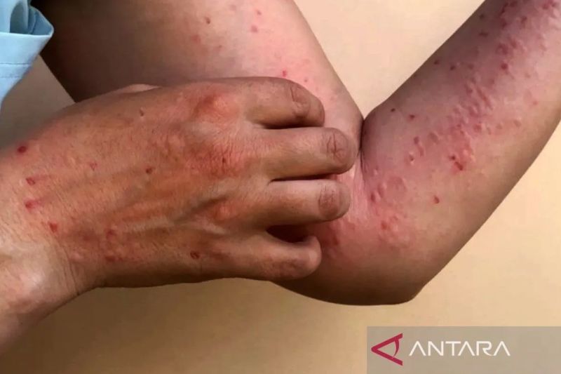 Waspada Penularan MPOX! 88 Kasus Dikonfirmasi Tersebar di Indonesia, Jakarta Terbanyak