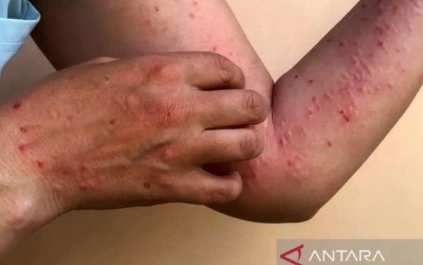 Waspada Penularan MPOX! 88 Kasus Dikonfirmasi Tersebar di Indonesia, Jakarta Terbanyak