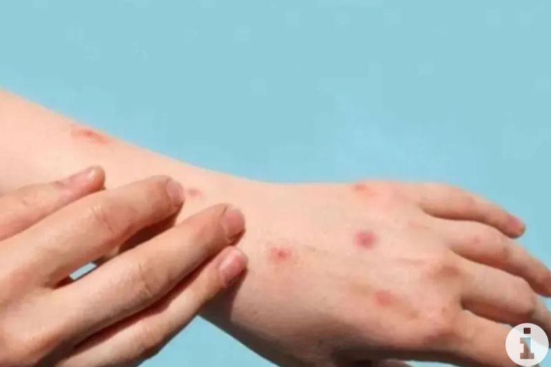 Ciri Khas Ruam Klinis yang Perlu Diwaspadai pada Penderita MPOX