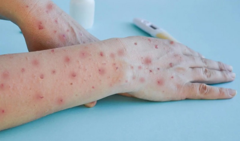 Waspada!! Virus Cacar Monyet Dapat Menular Lewat Kontak Seksual