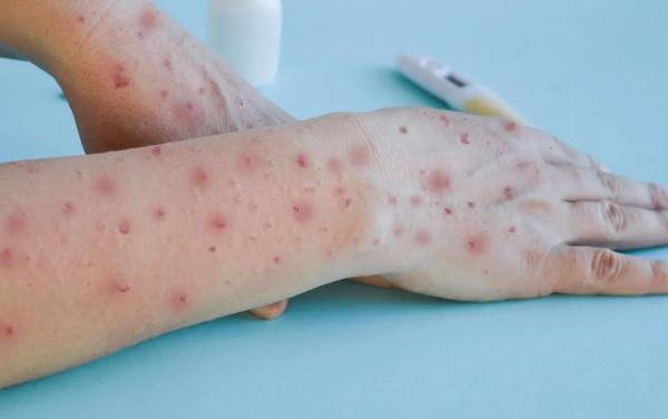 Menkes: Vaksin Cacar Monyet Masih Difokuskan untuk Kelompok Tertentu