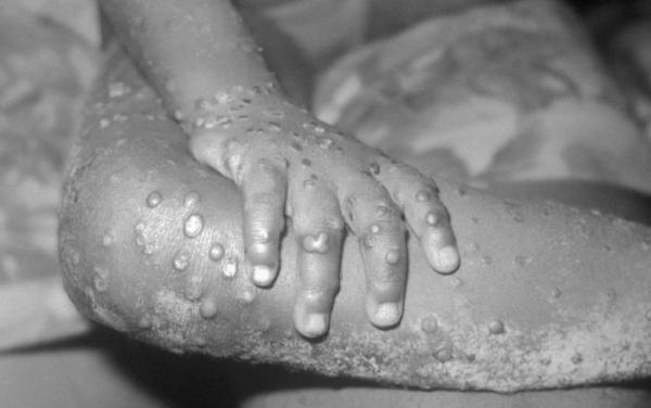 BRIN: Tingkat Penularan Virus MPOX Varian Clade IB Disebut Lebih Cepat