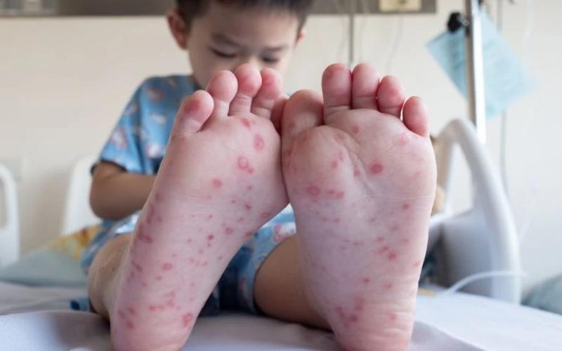 Ketahui Langkah Pencegahan dan Pengobatan Flu Singapura