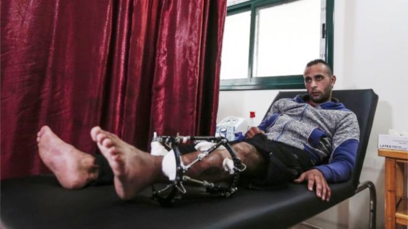 Ditembak Militer Israel, 1.700 Warga Palestina Harus Diamputasi