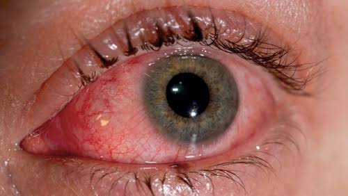 Bagaimana Virus Corona Masuk Lewat Mata?