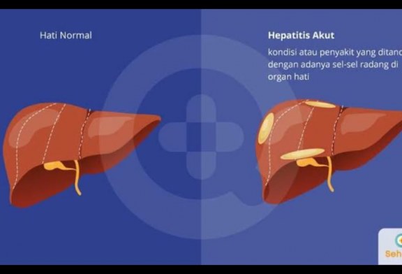 Cara Mencegah Hepatitis Akut yang Mematikan