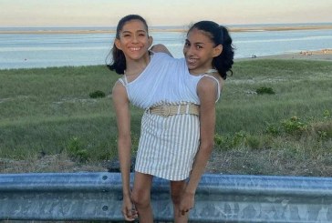 Wow! Anak Kembar Siam AS Ini Sudah Berusia 22 Tahun, Bisa Mengemudi dan Berkencan