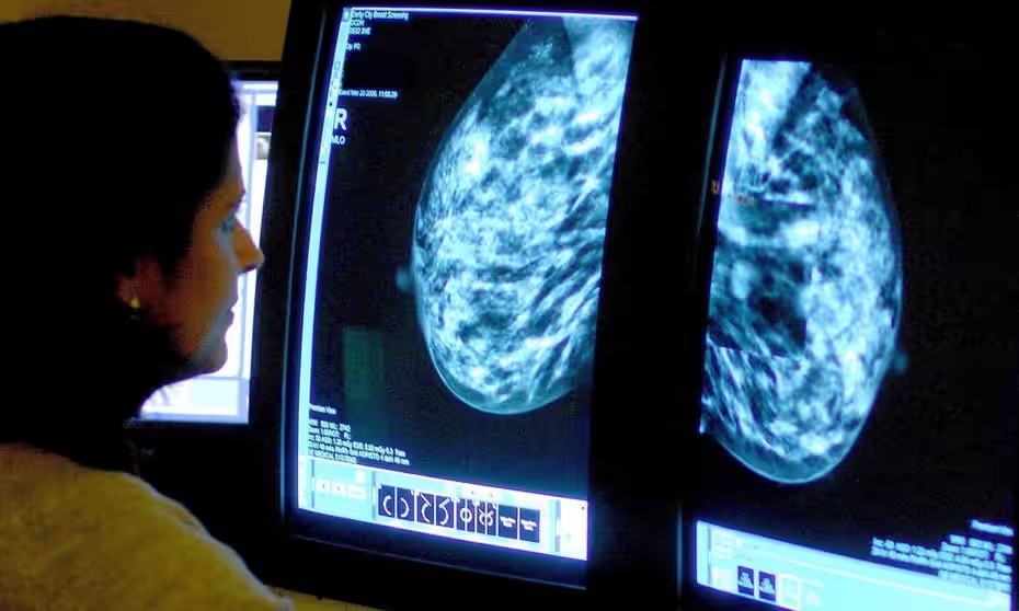 Temuan: Penggunaan AI dalam Skrining Kanker Payudara Sebaik Dua Ahli Radiologi